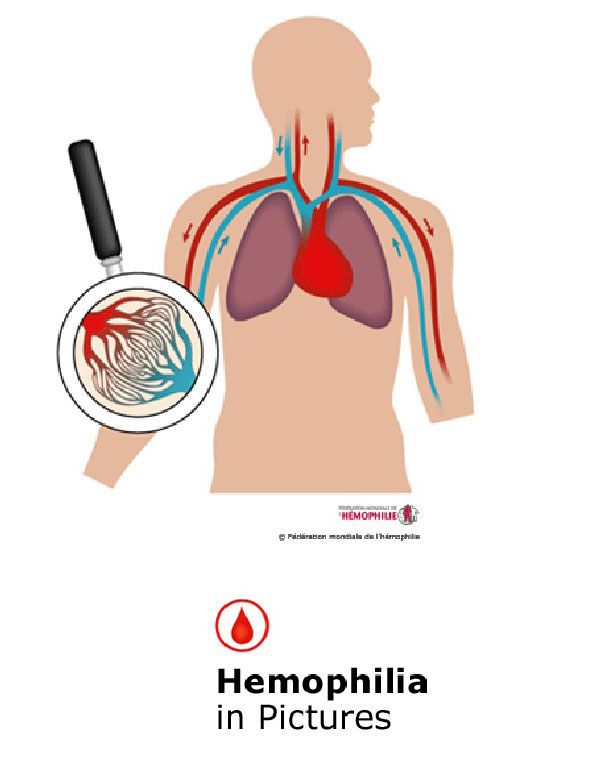 Hemophilia-in-Pictures-Farsi-1
